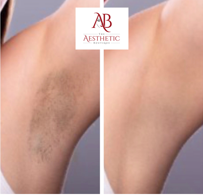 laser hair removal lafayette