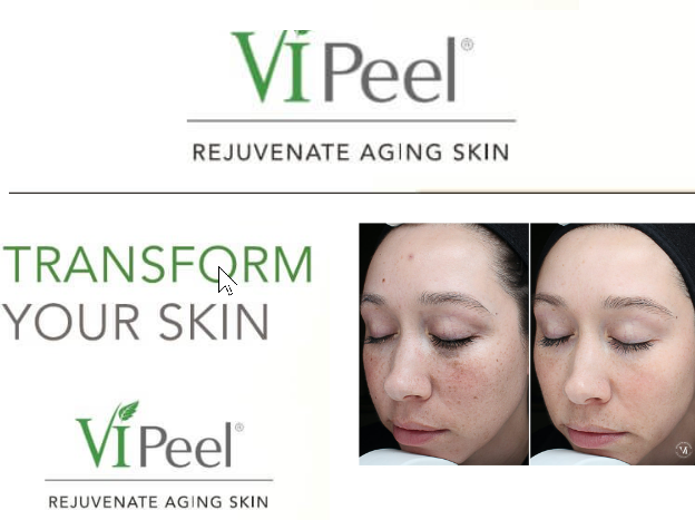 VI PEEL – A Flawless Complexion in 7 Days
